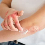 Navigating the Challenges of Assessing Childhood Psoriasis Severity: A Call for Standardization and Pediatric-Specific Measures
